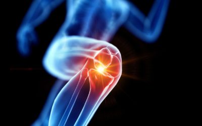 Was bedeutet „patellafemorales Schmerzsyndrom“ und was hilft bei dieser Form der Knieschmerzen?